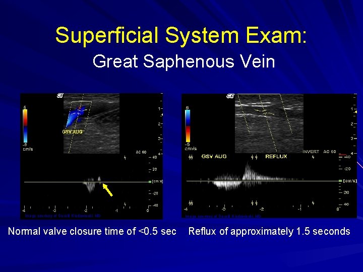Superficial System Exam: Great Saphenous Vein Image courtesy of Gerald Niedzwiecki, MD Normal valve