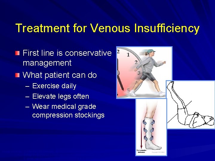 Treatment for Venous Insufficiency 1 First line is conservative management What patient can do