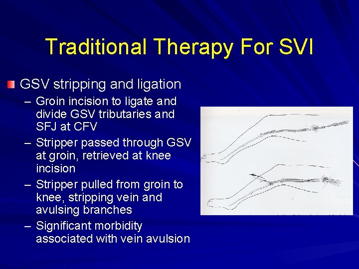 Traditional Therapy For SVI GSV stripping and ligation – Groin incision to ligate and