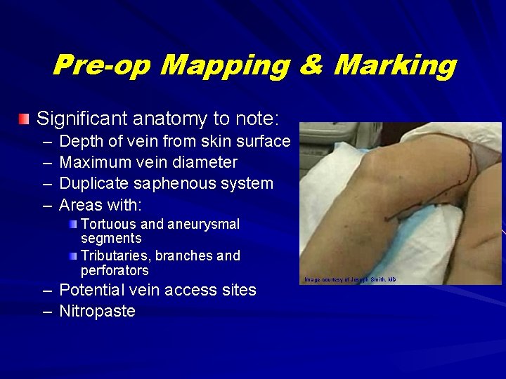 Pre-op Mapping & Marking Significant anatomy to note: – – Depth of vein from