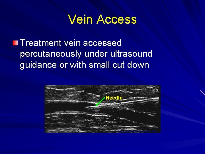 Vein Access Treatment vein accessed percutaneously under ultrasound guidance or with small cut down
