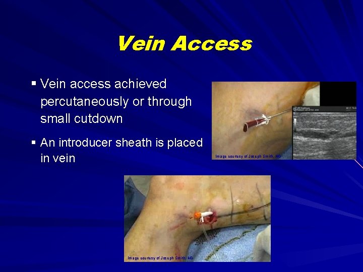 Vein Access § Vein access achieved percutaneously or through small cutdown § An introducer