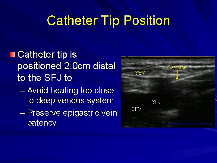 Catheter Tip Position Catheter tip is positioned 2. 0 cm distal to the SFJ
