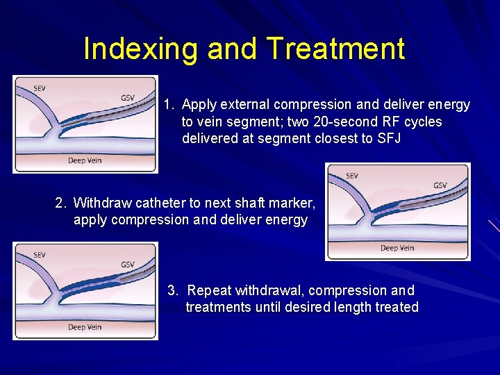 Indexing and Treatment 1. Apply external compression and deliver energy to vein segment; two