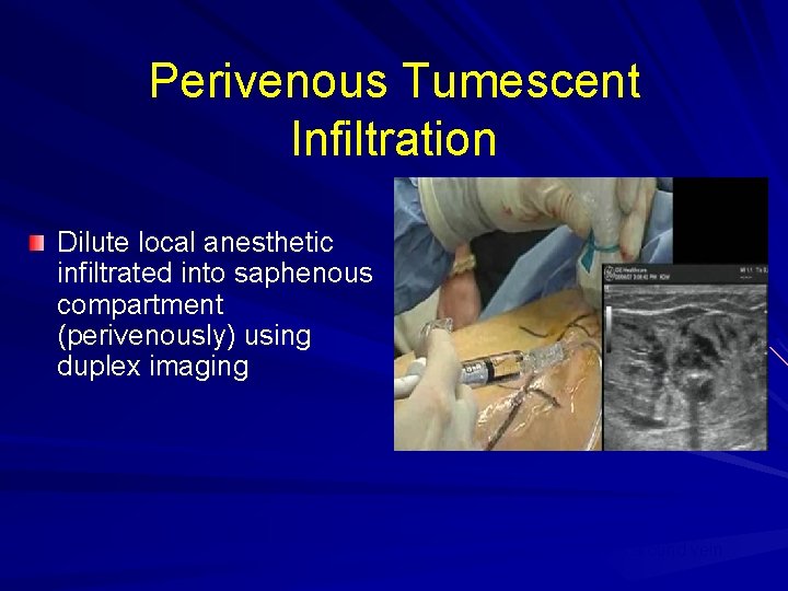 Perivenous Tumescent Infiltration Dilute local anesthetic infiltrated into saphenous compartment (perivenously) using duplex imaging