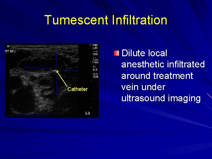 Tumescent Infiltration Catheter Image courtesy of Michael Vasquez, MD Note fluid encircling vein Dilute