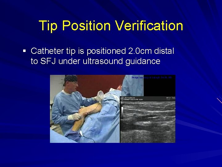 Tip Position Verification § Catheter tip is positioned 2. 0 cm distal to SFJ