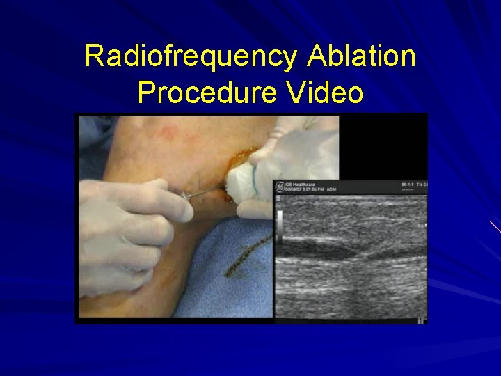 Radiofrequency Ablation Procedure Video 