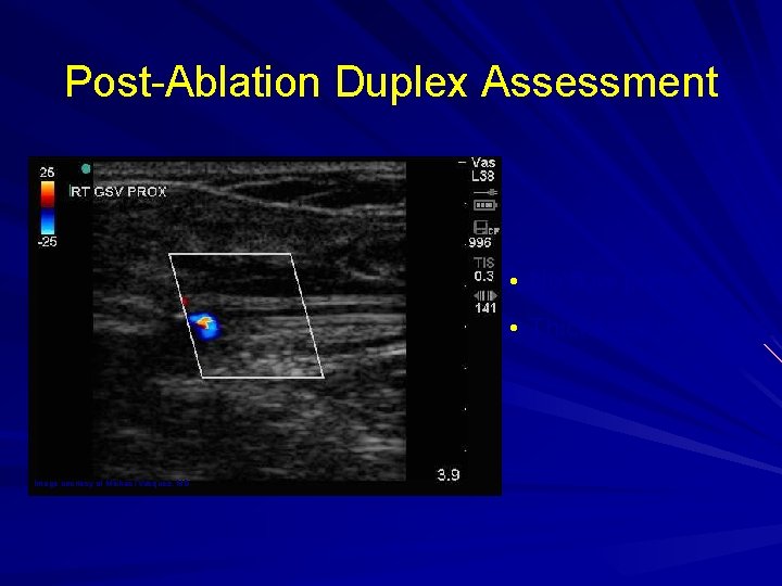 Post-Ablation Duplex Assessment • No flow present • Thickened vein walls Image courtesy of