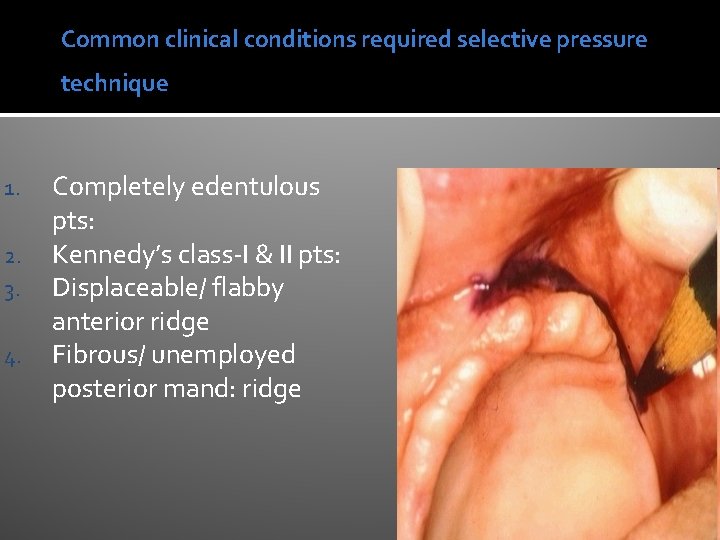 Common clinical conditions required selective pressure technique 1. 2. 3. 4. Completely edentulous pts: