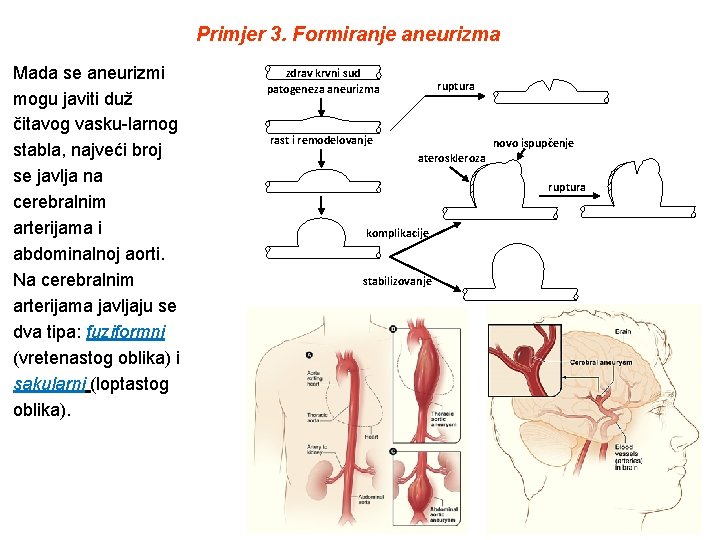 Primjer 3. Formiranje aneurizma Mada se aneurizmi mogu javiti duž čitavog vasku-larnog stabla, najveći