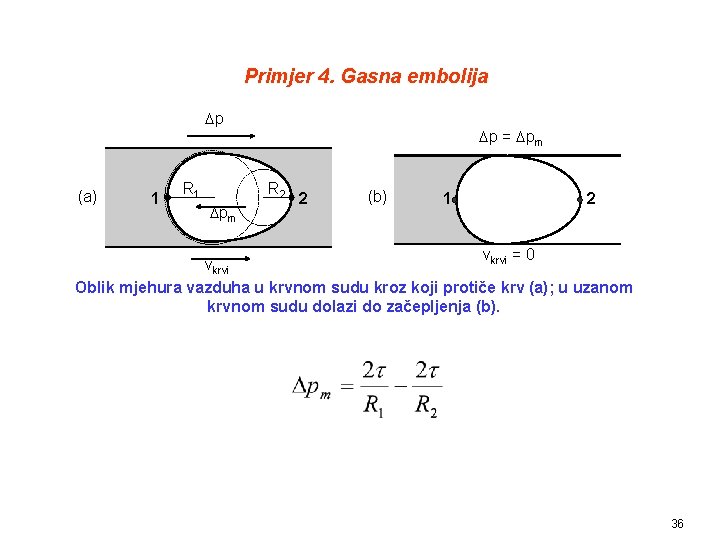 Primjer 4. Gasna embolija p (a) 1 R 1 p = pm R 2