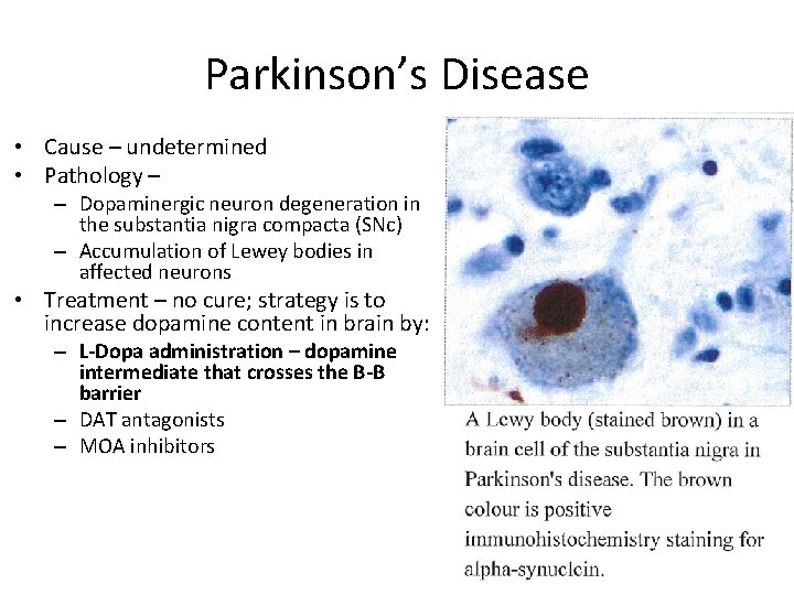 Parkinson’s Disease • Cause – undetermined • Pathology – – Dopaminergic neuron degeneration in