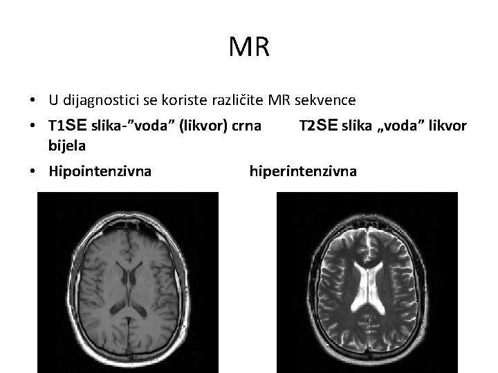 MR • U dijagnostici se koriste različite MR sekvence • T 1 SE slika-”voda”