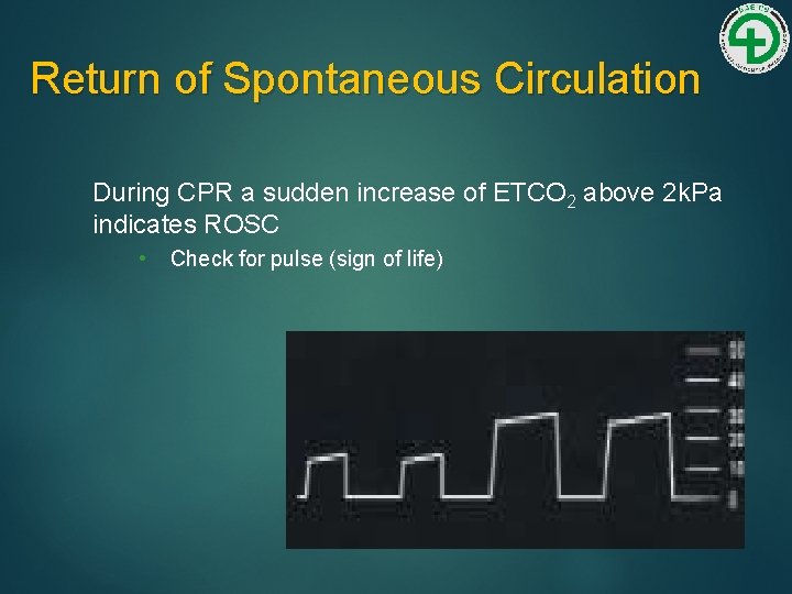 Return of Spontaneous Circulation During CPR a sudden increase of ETCO 2 above 2