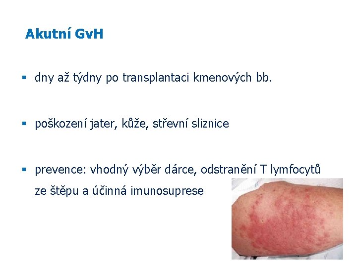  Akutní Gv. H dny až týdny po transplantaci kmenových bb. poškození jater, kůže,