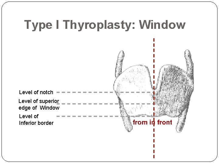 Type I Thyroplasty: Window Level of notch Level of superior edge of Window Level