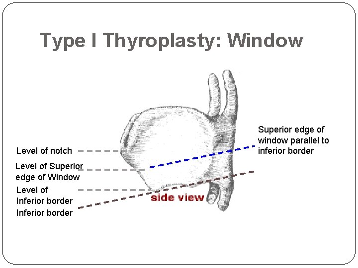 Type I Thyroplasty: Window Level of notch Level of Superior edge of Window Level
