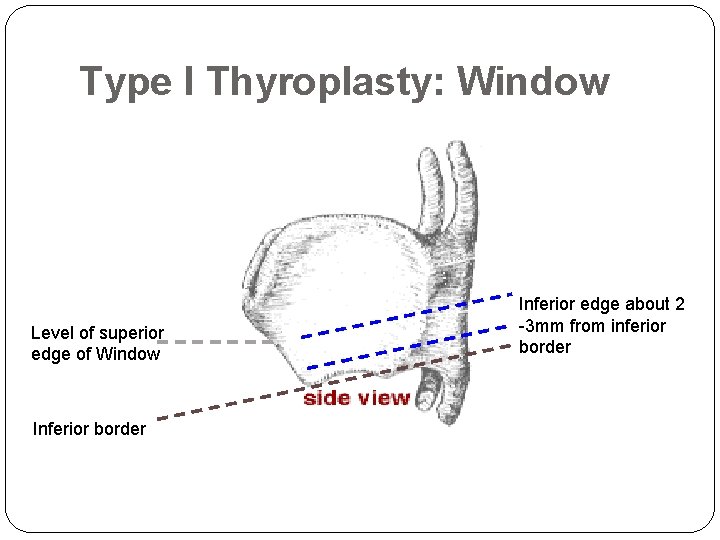Type I Thyroplasty: Window Level of superior edge of Window Inferior border Inferior edge