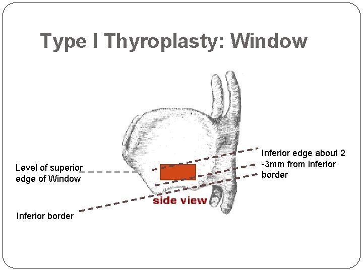 Type I Thyroplasty: Window Level of superior edge of Window Inferior border Inferior edge