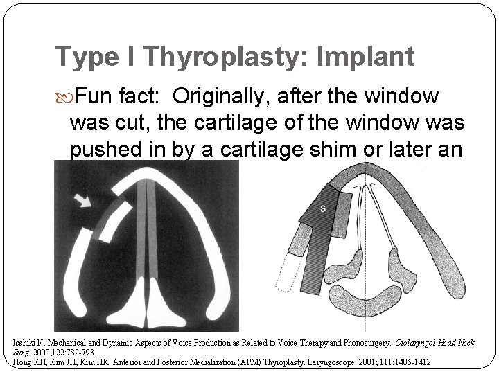 Type I Thyroplasty: Implant Fun fact: Originally, after the window was cut, the cartilage