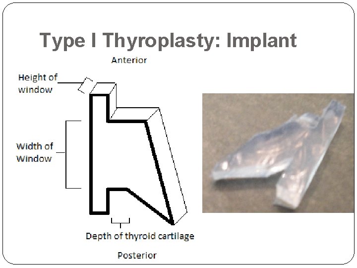 Type I Thyroplasty: Implant 
