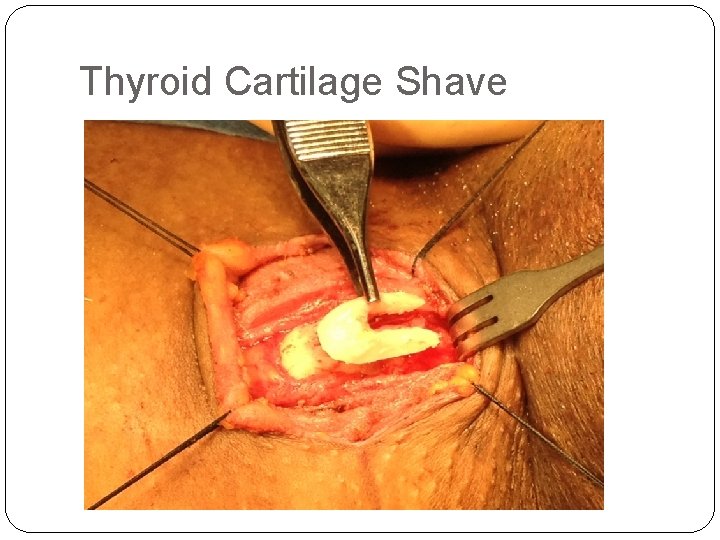 Thyroid Cartilage Shave 