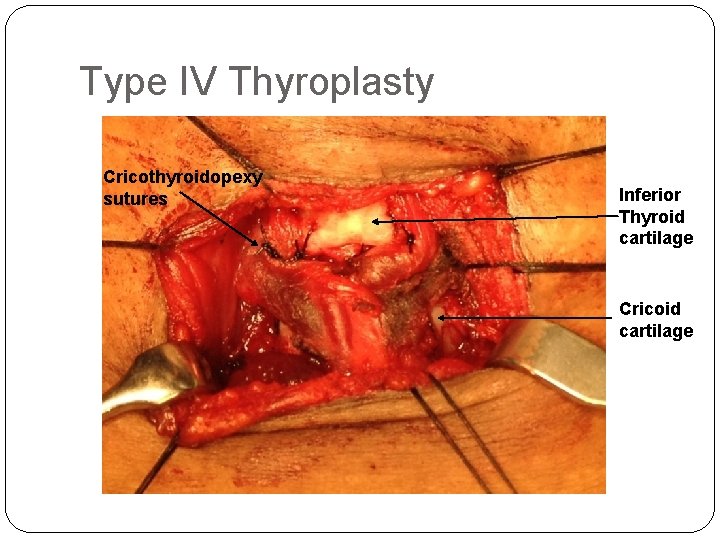 Type IV Thyroplasty Cricothyroidopexy sutures Inferior Thyroid cartilage Cricoid cartilage 