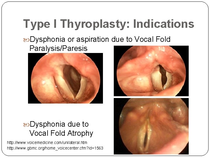 Type I Thyroplasty: Indications Dysphonia or aspiration due to Vocal Fold Paralysis/Paresis Dysphonia due