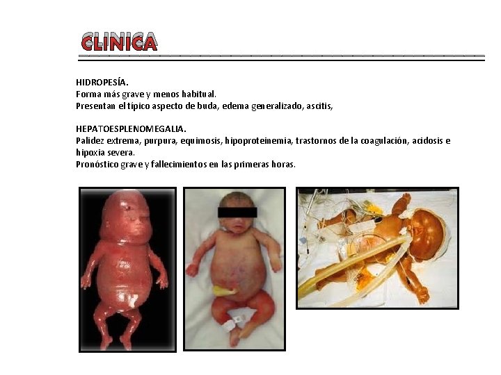 CLINICA ____________________ HIDROPESÍA. Forma más grave y menos habitual. Presentan el típico aspecto de