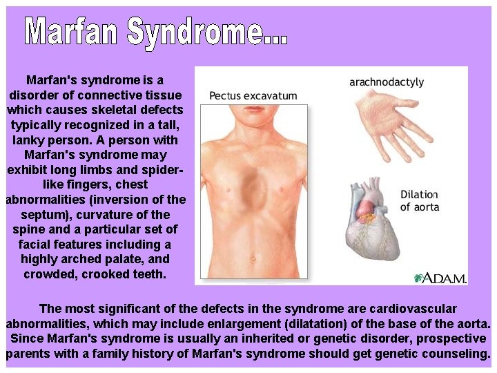 Marfan's syndrome is a disorder of connective tissue which causes skeletal defects typically recognized