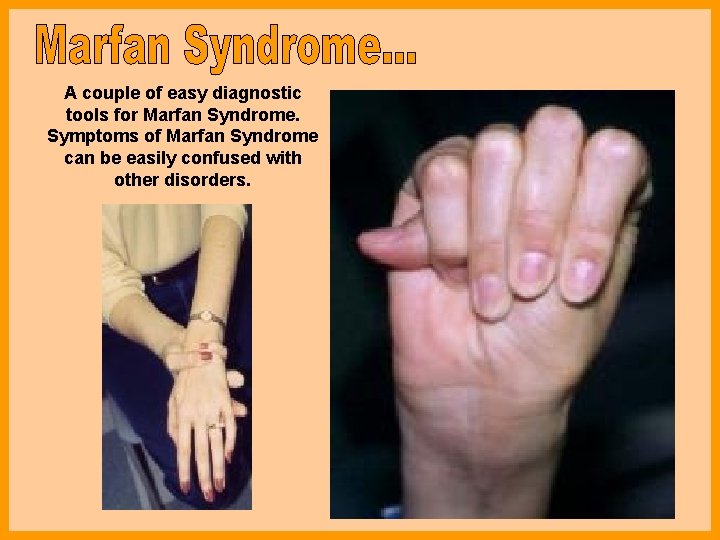 A couple of easy diagnostic tools for Marfan Syndrome. Symptoms of Marfan Syndrome can