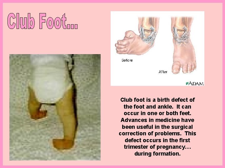 Club foot is a birth defect of the foot and ankle. It can occur