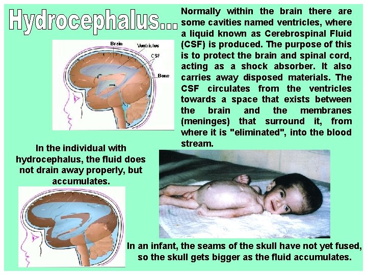 In the individual with hydrocephalus, the fluid does not drain away properly, but accumulates.