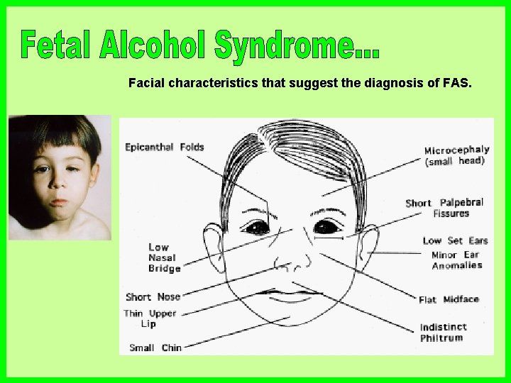 Facial characteristics that suggest the diagnosis of FAS. 