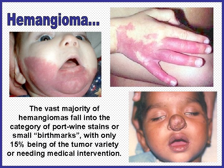 The vast majority of hemangiomas fall into the category of port-wine stains or small