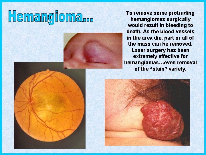 To remove some protruding hemangiomas surgically would result in bleeding to death. As the