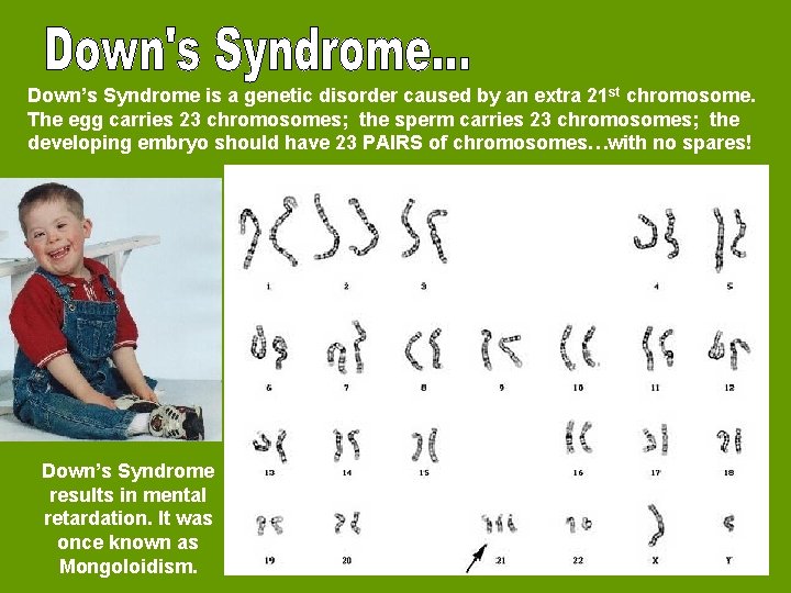 Down’s Syndrome is a genetic disorder caused by an extra 21 st chromosome. The