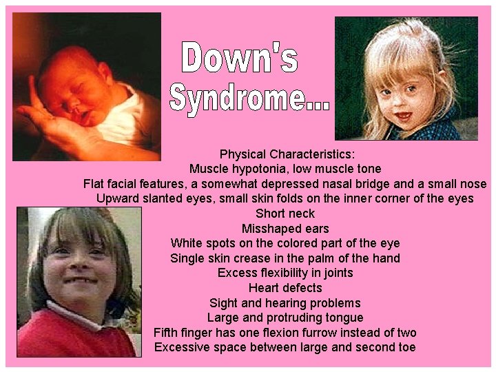 Physical Characteristics: Muscle hypotonia, low muscle tone Flat facial features, a somewhat depressed nasal