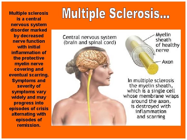 Multiple sclerosis is a central nervous system disorder marked by decreased nerve function with