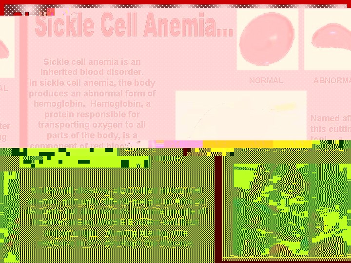Sickle cell anemia is an inherited blood disorder. In sickle cell anemia, the body