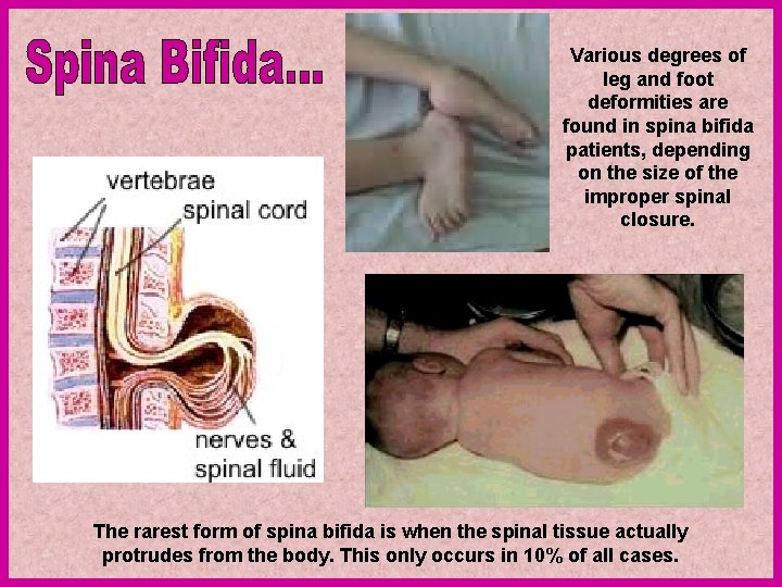 Various degrees of leg and foot deformities are found in spina bifida patients, depending