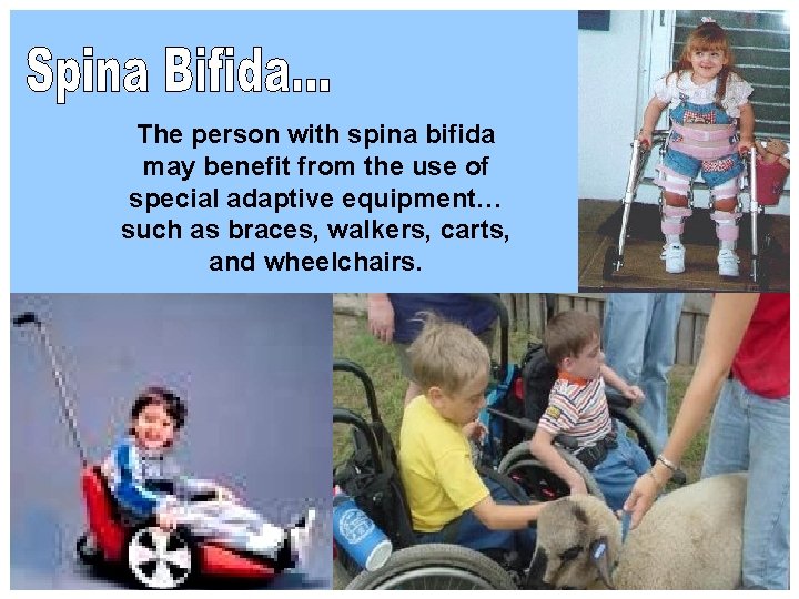 The person with spina bifida may benefit from the use of special adaptive equipment…