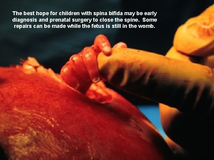 The best hope for children with spina bifida may be early diagnosis and prenatal