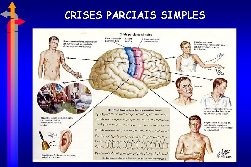 CRISES PARCIAIS SIMPLES 