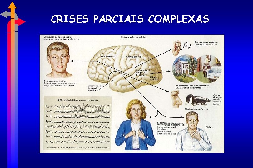 CRISES PARCIAIS COMPLEXAS 