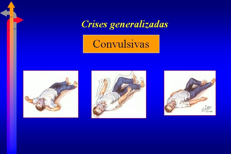 Crises generalizadas Convulsivas 