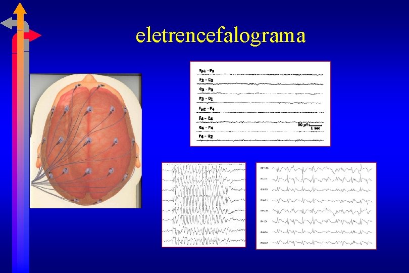 eletrencefalograma 