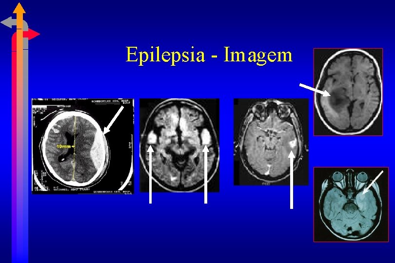 Epilepsia - Imagem 