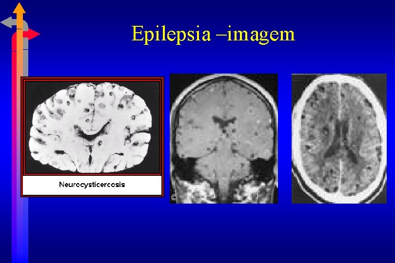 Epilepsia –imagem 